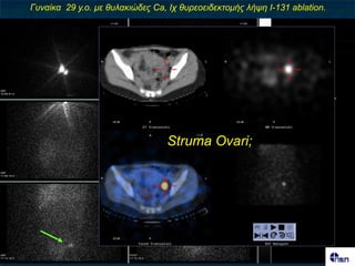 Γσλαίθα 29 y.o. κε ζσιαθηώδες Ca, Ιτ ζσρεοεηδεθηοκής ιήυε Ι-131 ablation.




                                 Struma Ovari;
 