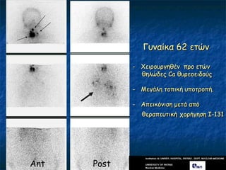 Γοκαίθα 62 εηώκ

             - Υεηνμονγεζέκ πνμ εηώκ
               ζειώδεξ Ca ζονεμεηδμύξ

             - Μεγάιε ημπηθή οπμηνμπή.

             - Απεηθόκηζε μεηά από
               ζεναπεοηηθή πμνήγεζε Ι-131




Ant   Post
 