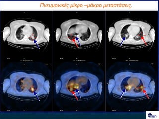Πλεσκοληθές κίθρο –κάθρο κεηαζηάζεης.
 