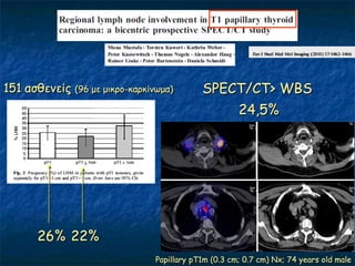 151 αζζεκείξ (96 με μηθνμ-θανθίκςμα)        SPECT/CT> WBS
                                                      24,5%




       26% 22%
                                Papillary pT1m (0.3 cm; 0.7 cm) Nx; 74 years old male
 