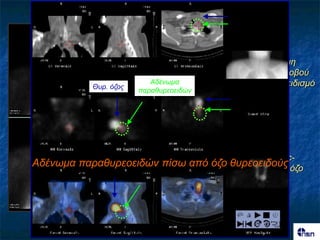 Αζζελής κε κεγάιο κε
                                        ιεηηοσργηθό όδο ΑΡ ιοβού
                          Αδέλφκα       θαη σπερπαραζσρεοεηδηζκό
           Θσρ. όδος
                       παραζσρεοεηδώλ

      Πνςσμε ιήρε


                                   Πρόζιευε 99mTc-
Αδέλφκα παραζσρεοεηδώλ πίζφ από όδο ζσρεοεηδούς όδο
                                 Sestamibi από ηολ


          2 ώνεξ
 