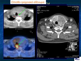 Οπηζζο-ηρατεηαθό αδέλφκα
                 ΓΝΣΟΠΙ΢Η




                             Ονζόημπμ
Mibi early       Mibi late
                             αδέκςμα;
 Pertechnetate




                 Αθαίνεζε
 