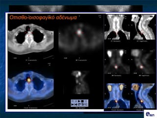 Οπηζζο-οηζοθαγηθό αδέλφκα




        Πνώσμε                        2 ώνεξ

                    Φοπνόξ
                  ζονεμεηδηθόξ
                     όδμξ                      Όδμξ




                                            Αδέκςμα
         Tc-99m                  Αθαίνεζε
 