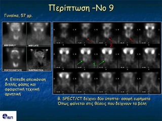 Πενίπηςζε –Νμ 9
Γοκαίθα, 57 πν.




MIBI EARLY      MIBI LATE                                2.



                                                 1.
PERTECHNETATE   SUBTRACTION



Α. Γπίπεδε απεηθόκηζε
δηπιήξ θάζεξ θαη
αθαηνεηηθή ηεπκηθή
ανκεηηθή
                                B. SPECT/CT δείπκεη δύμ ύπμπηα- αζαθή εονήμαηα
                                Όπςξ θαίκεηαη ζηηξ ζέζεηξ πμο δείπκμοκ ηα βέιε
 