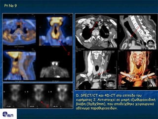 Pt No 9




              2




                  D. SPECT/CT θαη 4D-CT ζημ επίπεδμ ημο
                  εονήμαημξ 2. Ακηηζημηπεί ζε μηθνή ελςζονεμεηδηθή
                  βιάβε (9π8π9mm), πμο απμδείπζεθε πεηνμονγηθά
          2
                  αδέκςμα παναζονεμεηδώκ.
 