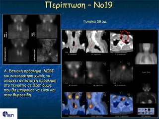 Πενίπηςζε – Νμ19
                                          Γοκαίθα 58 πν.
EARLY




                 LATE
                 MIBI
MIBI
 PERTWCHNETATE




                   SUBTRACTION




A. Γζηηαθή πνόζιερε MIBI
θαη θαηαθνάηεζε πςνίξ κα
οπάνπεη ακηίζημηπε πνόζιερε
ζημ ηεκπήηημ ζε ζέζε όμςξ
πμο ζα μπμνμύζε κα είκαη θαη
ζημκ ζονεμεηδή.
 