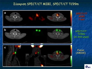 ΢ύγθνηζε SPECT/CT MIBI, SPECT/CT TC99m


                                    SPECT/CT
                                      MIBI
                                      1 ώνα




                                    SPECT/CT
                                       TC99m
                                   (ζε άιιε μένα)




                                     Fusion
                                    (AMIDE)
 