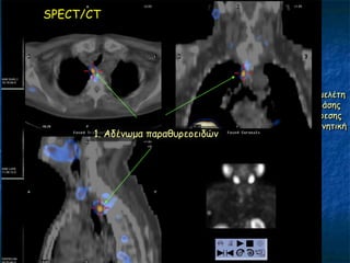 SPECT/CT




                                   Γπίπεδε μειέηε
                                    δηπιήξ θάζεξ
                                    θαη αθαίνεζεξ
                                   πηζακά ανκεηηθή
       1. Αδέκςμα παναζονεμεηδώκ
 