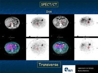 SPECT/CT

   IHA




Transverse
 