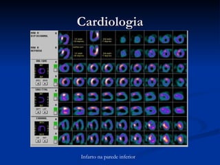 Cardiologia Infarto na parede inferior 