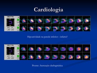 Cardiologia Pronte: Atenuação diafragmática Hipoatividade na parede inferior – infarto? 