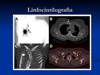 Linfocintilografia 