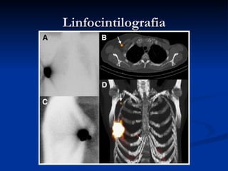 Linfocintilografia 