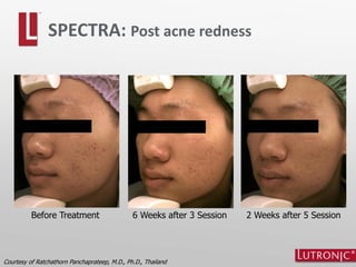 Courtesy of Ratchathorn Panchaprateep, M.D., Ph.D., Thailand
SPECTRA: Post acne redness
Before Treatment 6 Weeks after 3 Session 2 Weeks after 5 Session
 