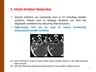 Metallic Disc Ct Spectral CT Imaging: Principle and Applications of Dual-Energy and ...
