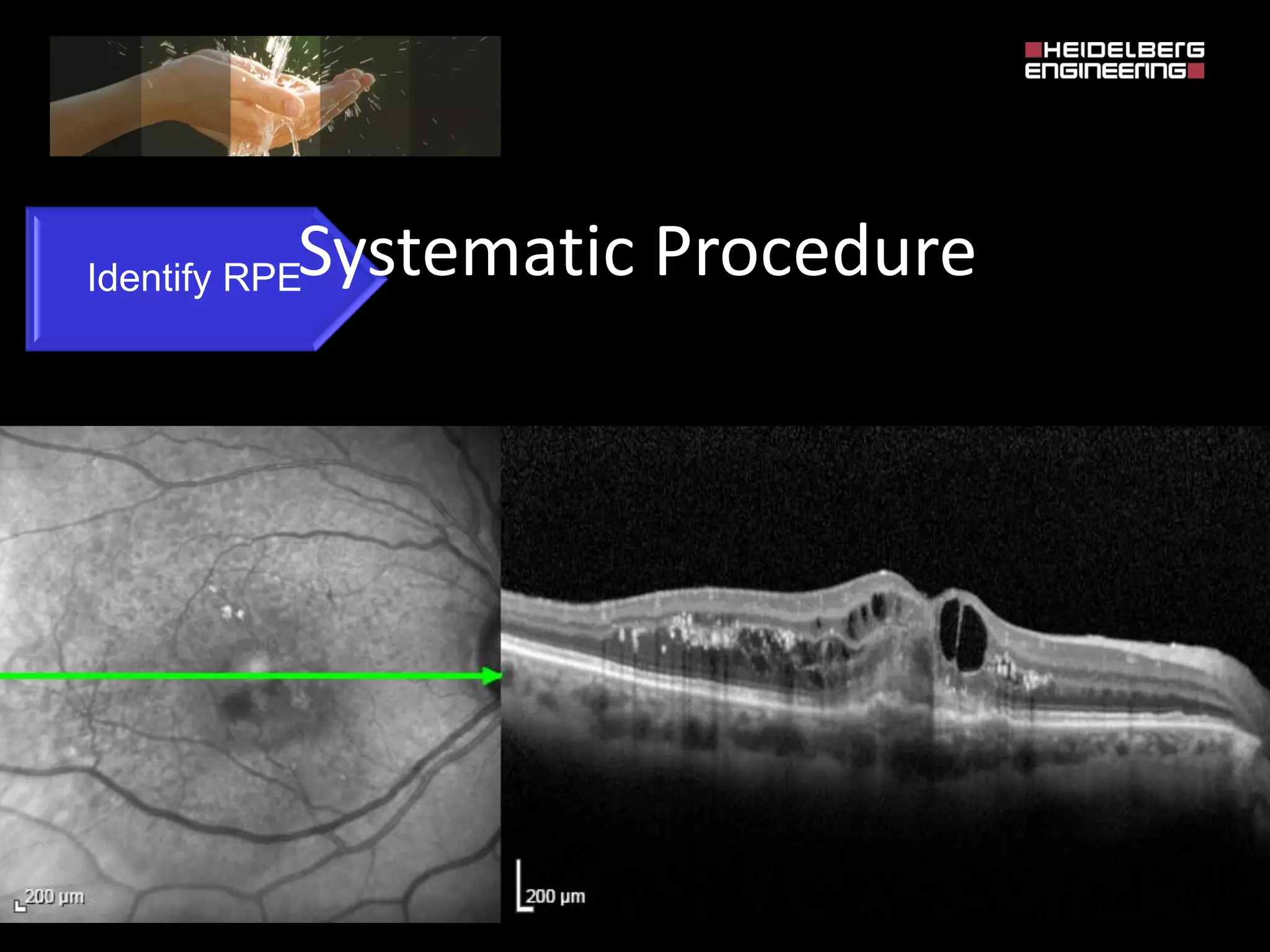 Spectralis oct normal anatomy & systematic interpretation. | PDF