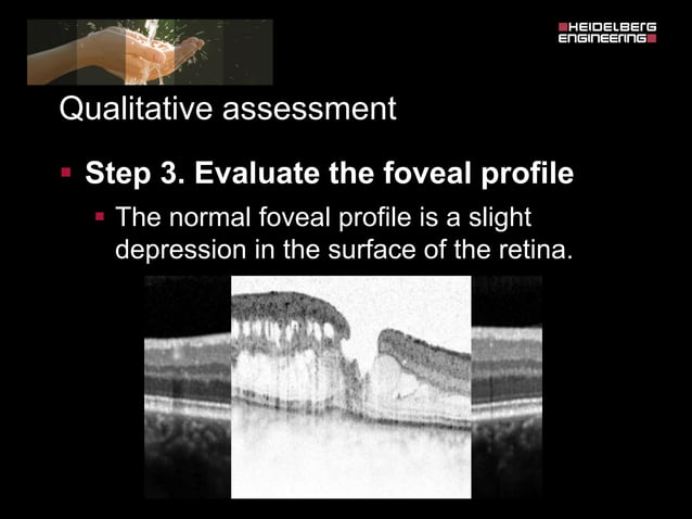 Spectralis oct normal anatomy & systematic interpretation. | PDF | Eye ...