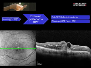 Spectralis oct normal anatomy & systematic interpretation. | PDF