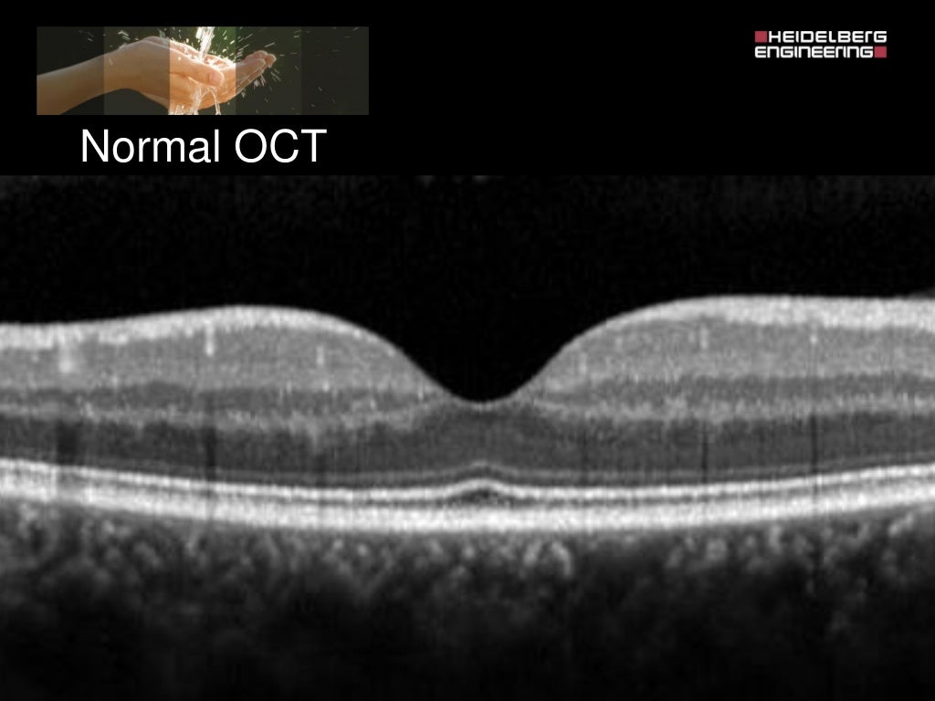 Spectralis oct normal anatomy & systematic interpretation.