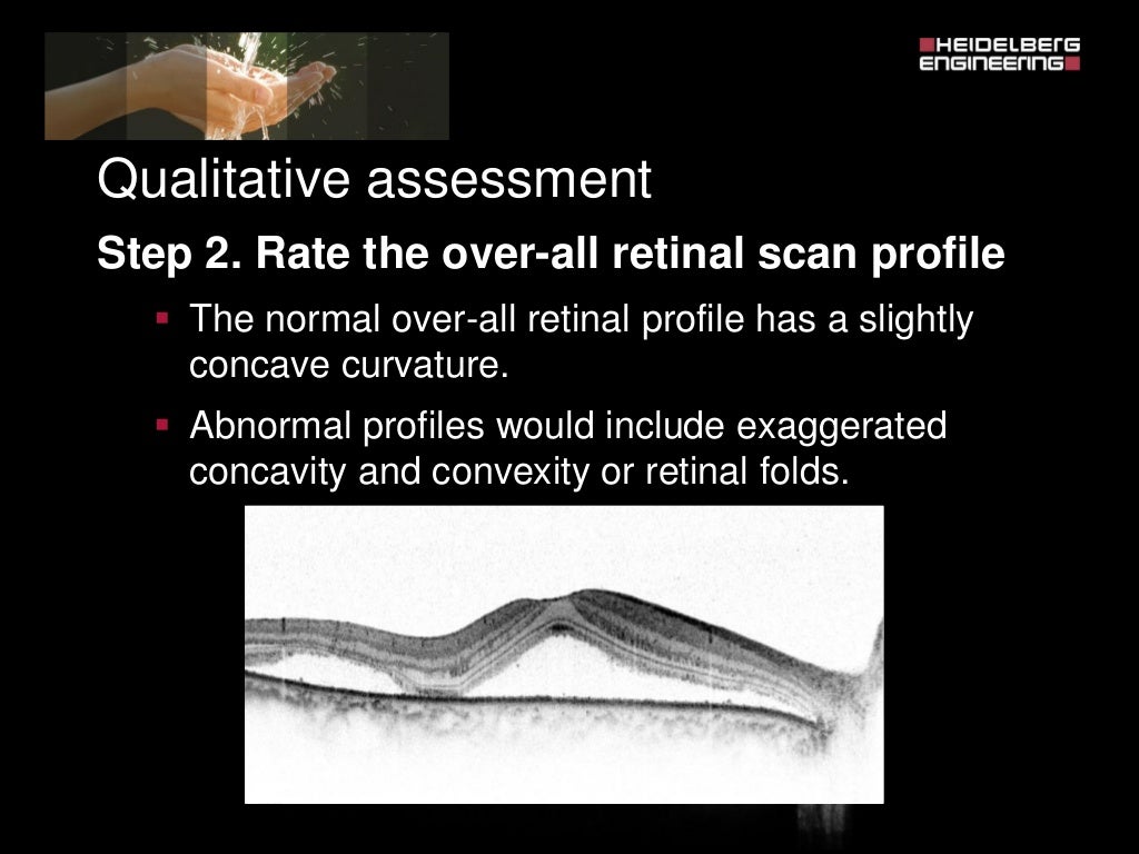 Spectralis oct normal anatomy & systematic interpretation.