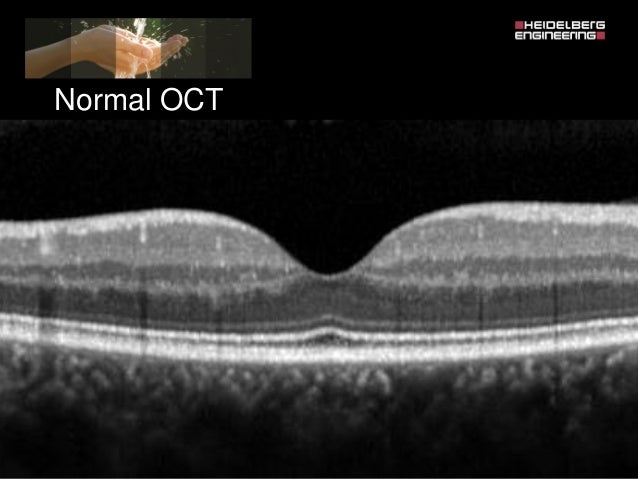 Oct 7 Line Raster Spectralis 7 line raster scan - systemshery
