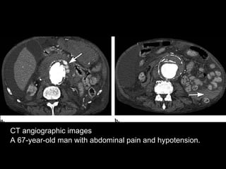 Spectrum Of Ct Findings In Rupture And Impendinging Rupture Of AAA | PPT