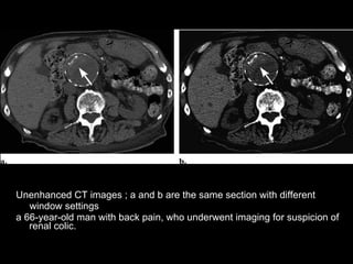 Spectrum Of Ct Findings In Rupture And Impendinging Rupture Of AAA | PPT