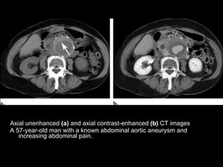 Spectrum Of Ct Findings In Rupture And Impendinging Rupture Of AAA | PPT