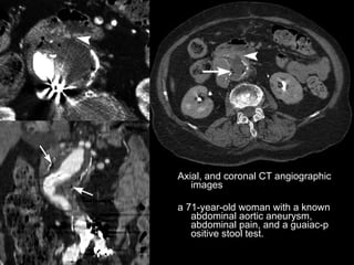 Spectrum Of Ct Findings In Rupture And Impendinging Rupture Of AAA | PPT