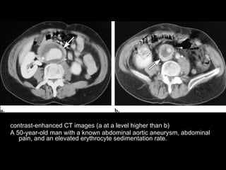 Spectrum Of Ct Findings In Rupture And Impendinging Rupture Of AAA | PPT