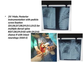 Spectrum_of_Spine_Surgery_Devdaha_Medical_College-1.pptx