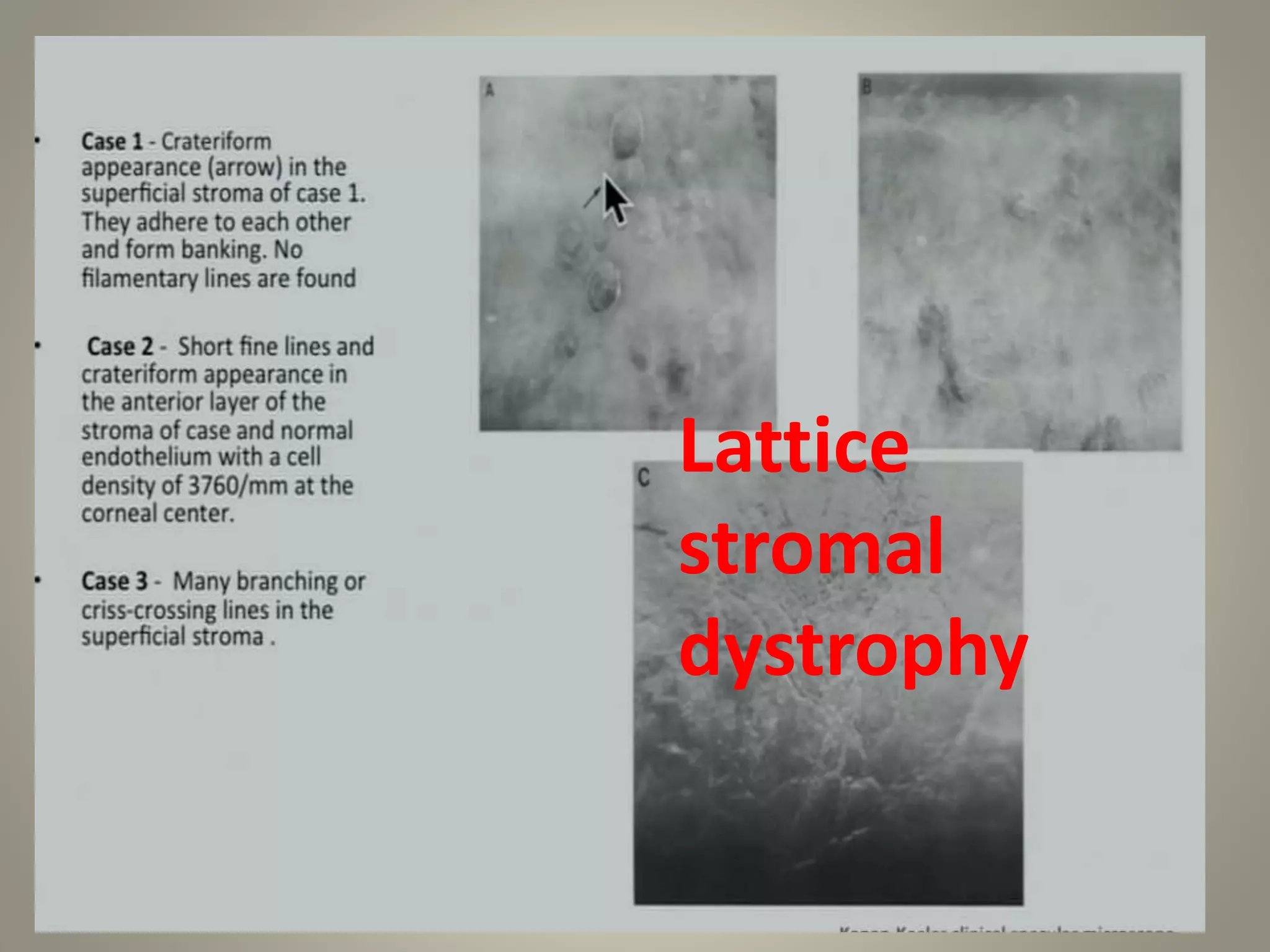 Lattice
stromal
dystrophy
 