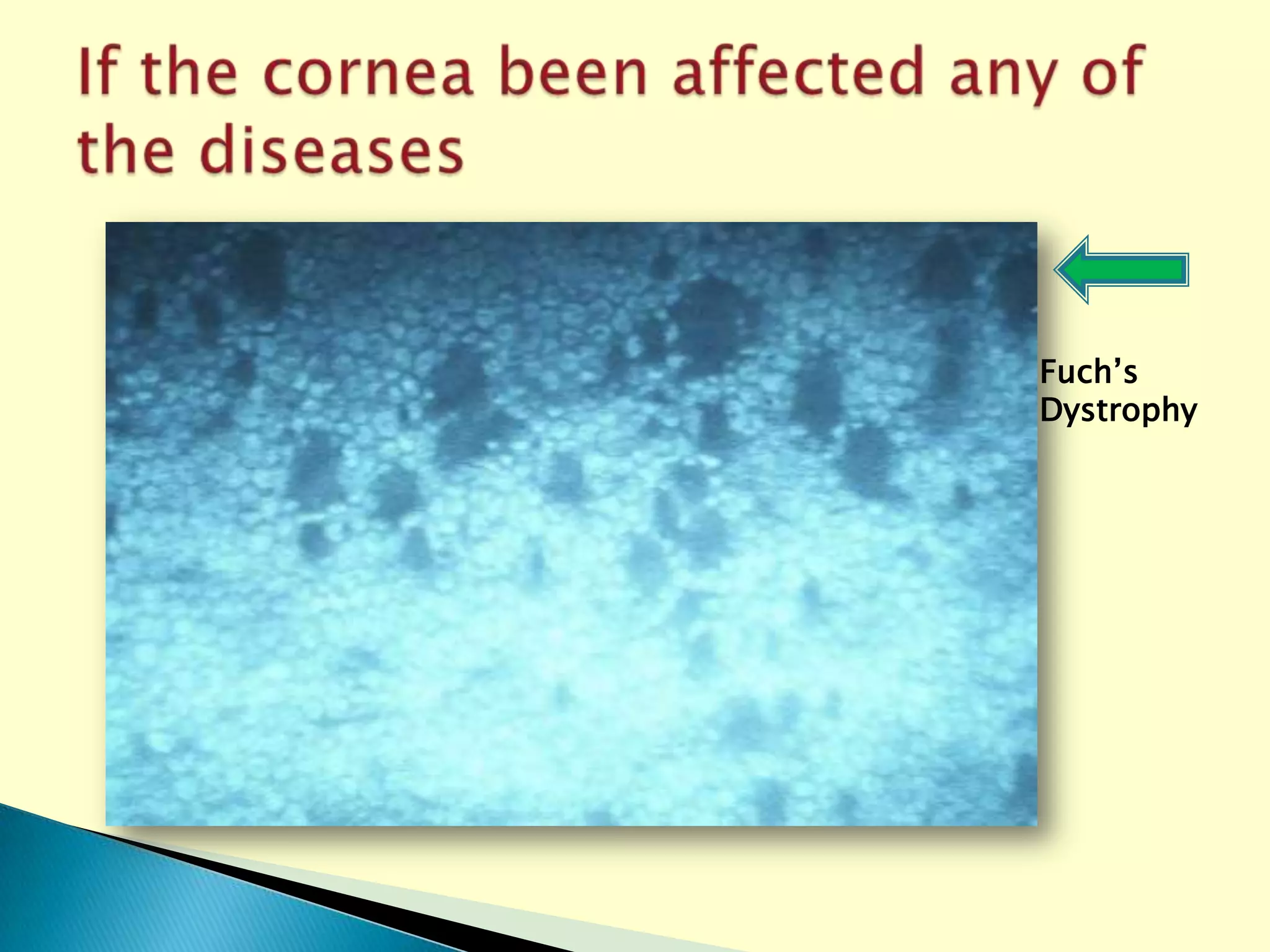 Eye Bank Specular Microscopy PPT