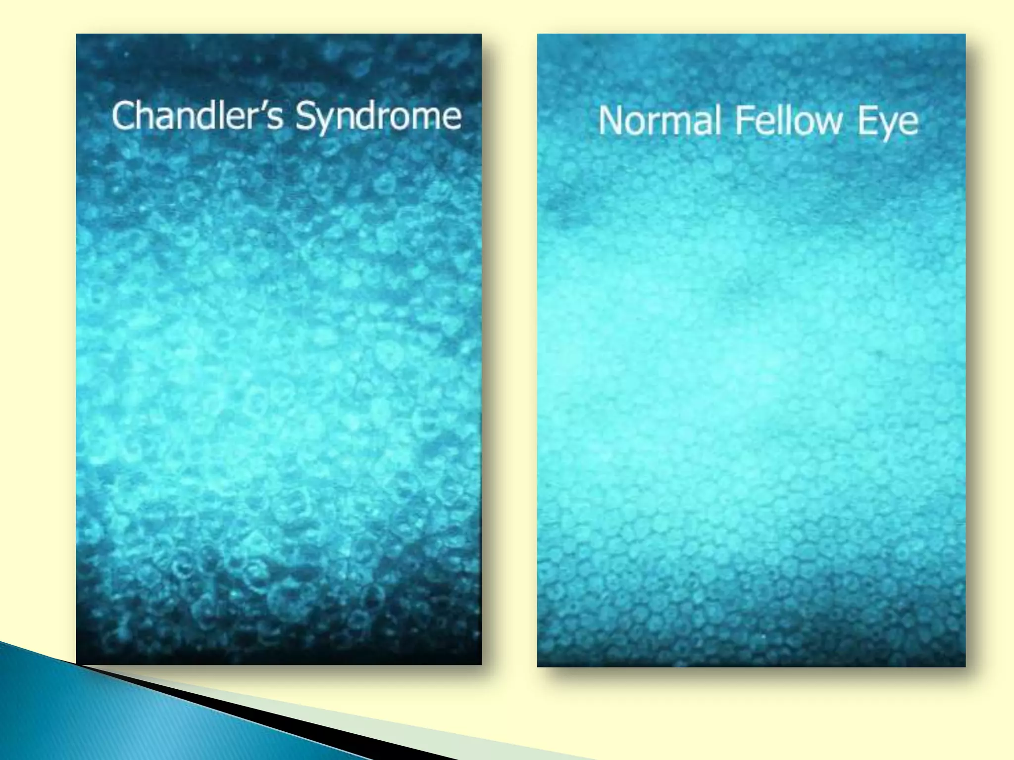 Eye Bank Specular Microscopy PPT