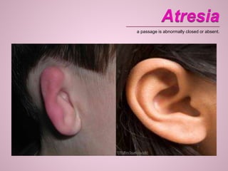 a passage is abnormally closed or absent.
 