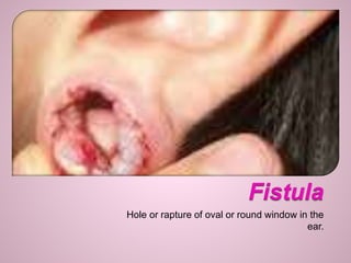 Hole or rapture of oval or round window in the
ear.
 