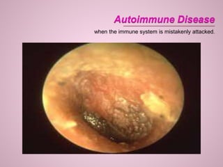 when the immune system is mistakenly attacked.
 