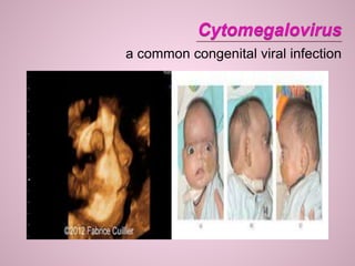 a common congenital viral infection
 