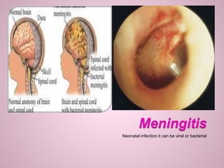 Neonatal infection it can be viral or bacterial
 