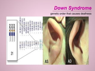 genetic order that causes deafness
 