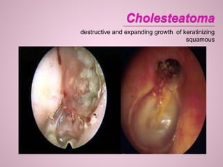 destructive and expanding growth of keratinizing
squamous
 
