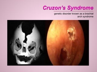 genetic disorder known as a brachial
arch syndrome
 