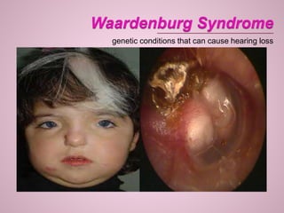 genetic conditions that can cause hearing loss
 