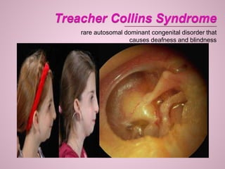 rare autosomal dominant congenital disorder that
causes deafness and blindness
 