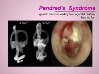 genetic disorder leading to congenital bilateral
hearing lost
 