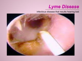 infectious disease that results hearing lost
 