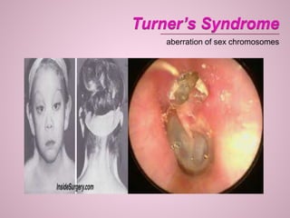 aberration of sex chromosomes
 