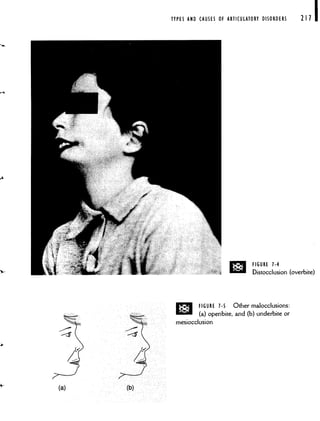TYPES AND CAUSES OF ARTICULATORY DISORDERS 211 I
D FIGURE 1-4
Distocclusion (overbite)
V
/—
(a) (b)
D FIGURE 1-5 Other malocclusions:
(a) openbite, and (b) underbite or
mesiocciusion
 