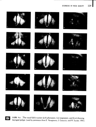 DISORDERS OF VOCAL QUALITY
• FIGII1 9-6 The vocal fold in action (a-h) phonation, (i-j) respiration, and (k-o) showing
laryngeal polyps (used by permission from E. Yanagisawa, J. Casuccio, and M. Suzuki, 1981).
329 1
 