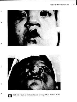INCIDENCE AND TYPES OF CLEFTS 341 I
I
D FIGURE 0-2 Clefts of the lip and palate (courtesyof Ralph Blocksma, MD.)
 
